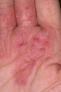 sintomi dell'allergia al nichel